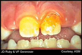 Biofilm Plaque