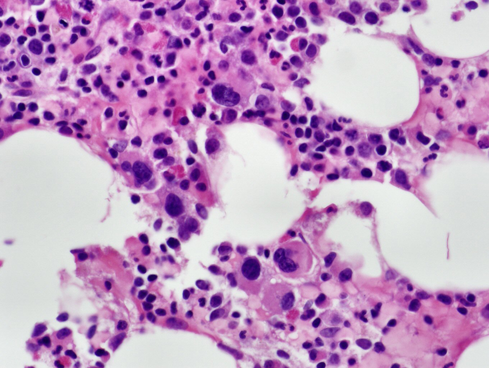 Normocellular bone marrow