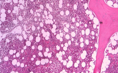 Normocellular bone marrow with progressive trilineage hematopoiesis