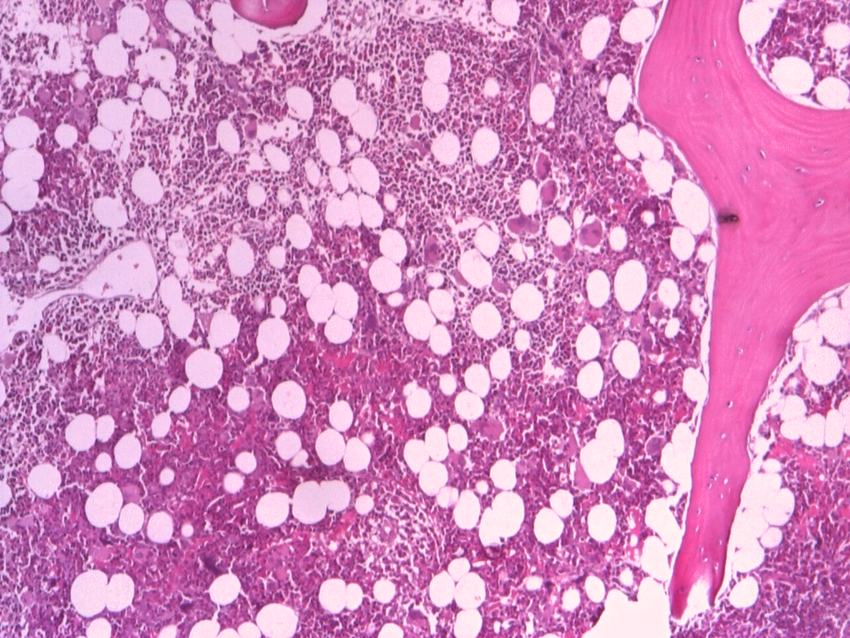 Normocellular bone marrow with progressive trilineage hematopoiesis