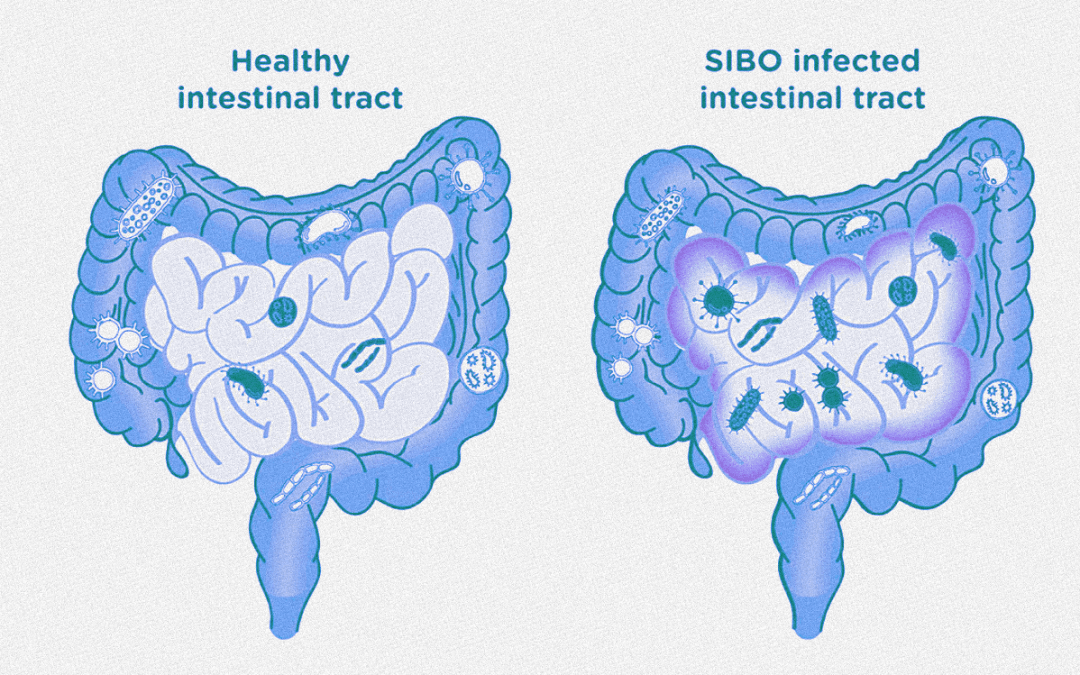 Small Intestinal Bacterial Overgrowth (SIBO) A Comprehensive Guide