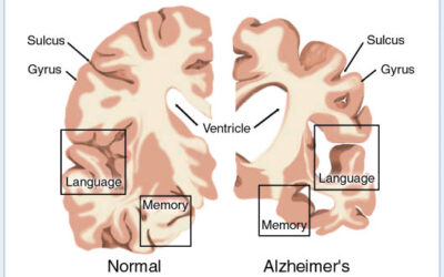 Diabetes, Insulin and Alzheimer’s Disease