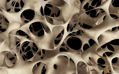 Osteoporosis – Supplements, Medications or Wolff’s Law