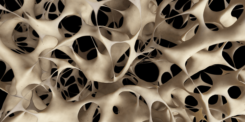 Osteoporosis – Supplements, Medications or Wolff’s Law